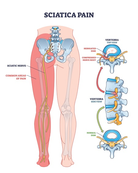 Sciatica